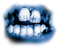 De giftiga ingredienserna i meth leder till kraftig tandröta, som kallas ”meth mouth” (”meth-mun”). Tänderna blir svarta, fläckiga och börjar ruttna, ofta till en punkt där de måste dras ut. Tänderna och tandköttet förstörs från insidan, och rötterna ruttnar bort.